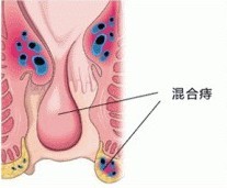 预防混合痔