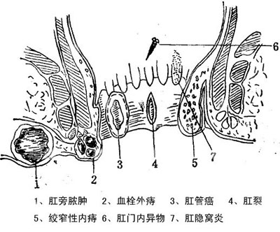 肛周疼痛