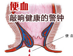 便血危害