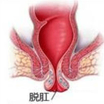 脱肛病理