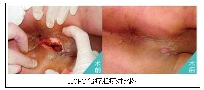 肛瘘手术治疗