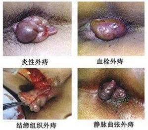 外痔