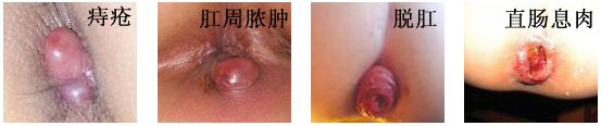 肛门肿物