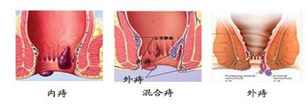 痔疮