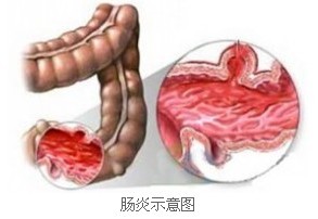结肠炎症状