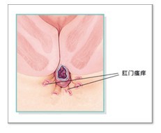 肛门痒痒