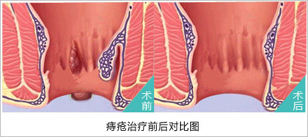痔疮