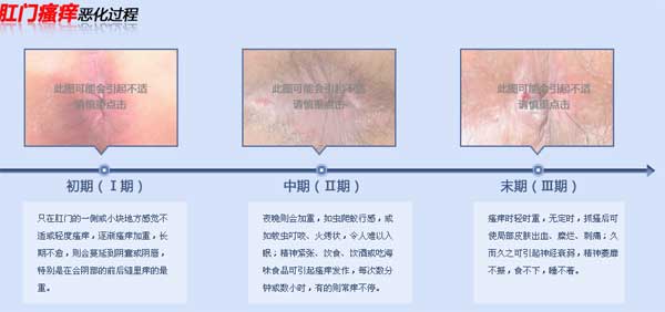 肛门瘙痒