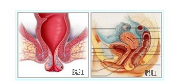 脱肛