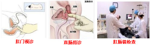 便血检查