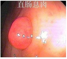直肠息肉图