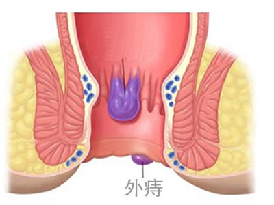 外痔分类