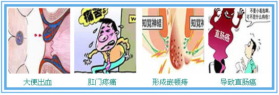 痔疮