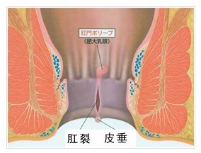 肛裂