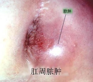 肛周脓肿特征