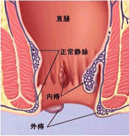 痔疮病因