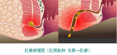 肛瘘发展