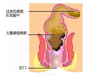 便秘危害
