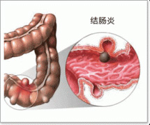 肠炎