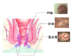 痔疮