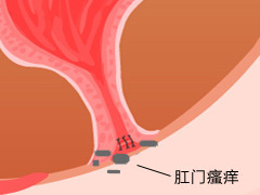 肛门瘙痒危害