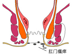 肛门瘙痒危害