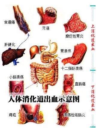 >>>>便血鮮紅是什麼原因?